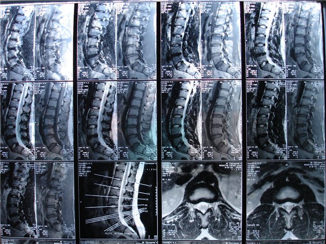 Міжхребцева грижа виникає при зміщенні пульпозного ядра міжхребцевого диска з розривом фіброзного кільця