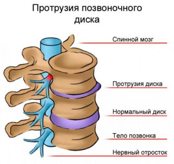 Протрузія дисків хребта - втрата контуром міжхребцевого диска властивої йому форми, що призводить до його випинання за межі хребця