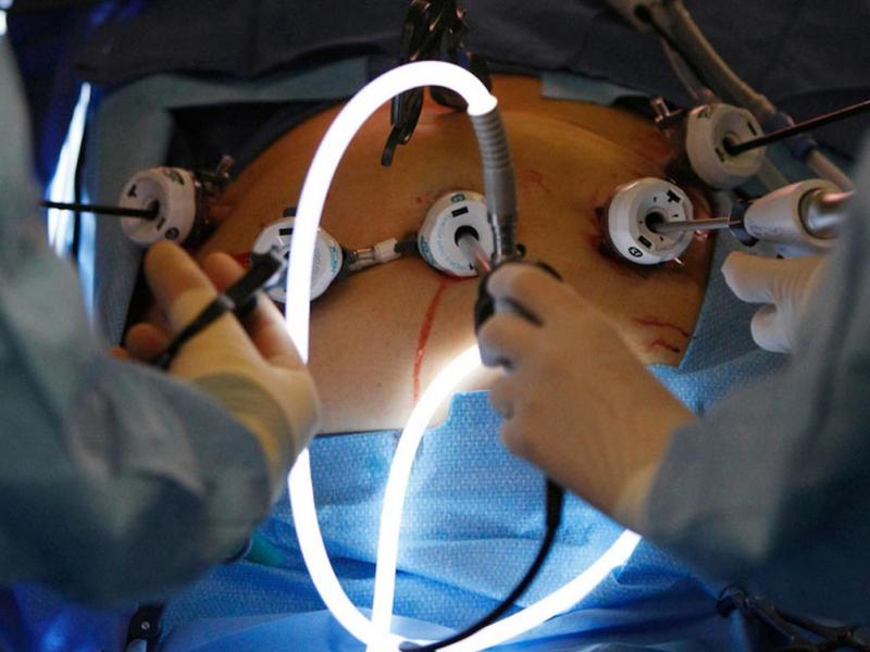 Что такое бариатрическая хирургия?