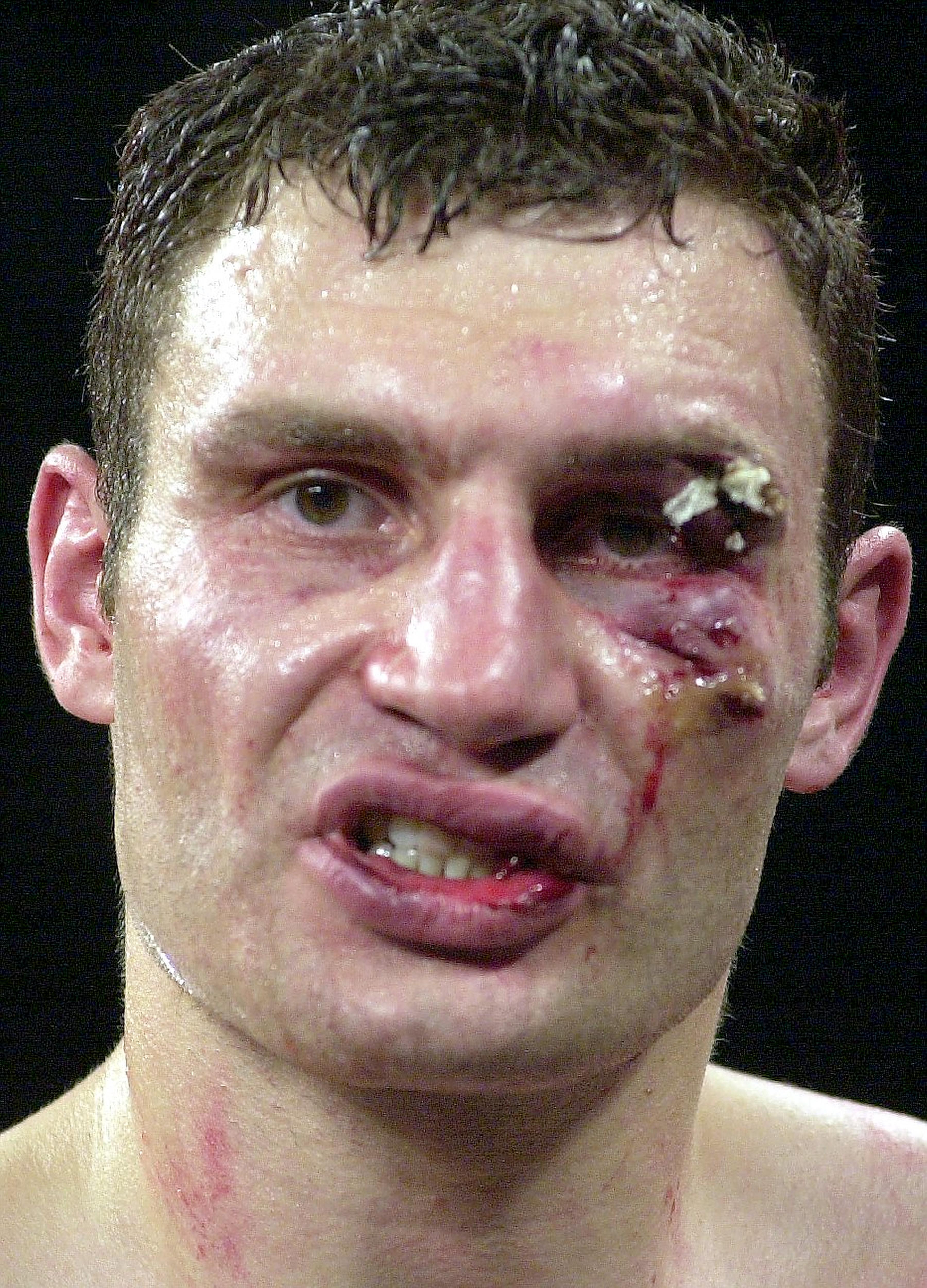 Кличко был вытащен доктором у ринга после того, как его глаз был разорван в клочья