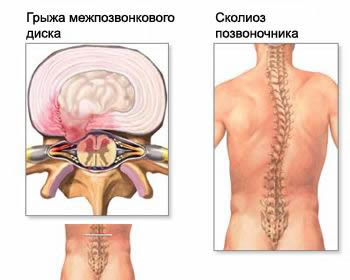 Часто руйнування міжхребцевого диска супроводжують м'язові   біль у спині